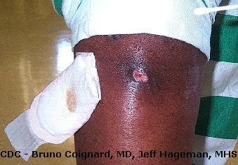 mrsa_arm_339x236